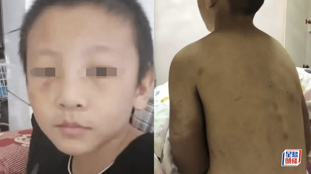 河南14歲少年慘遭生父繼母虐待致死 離世時穿紙尿褲肝肺受損