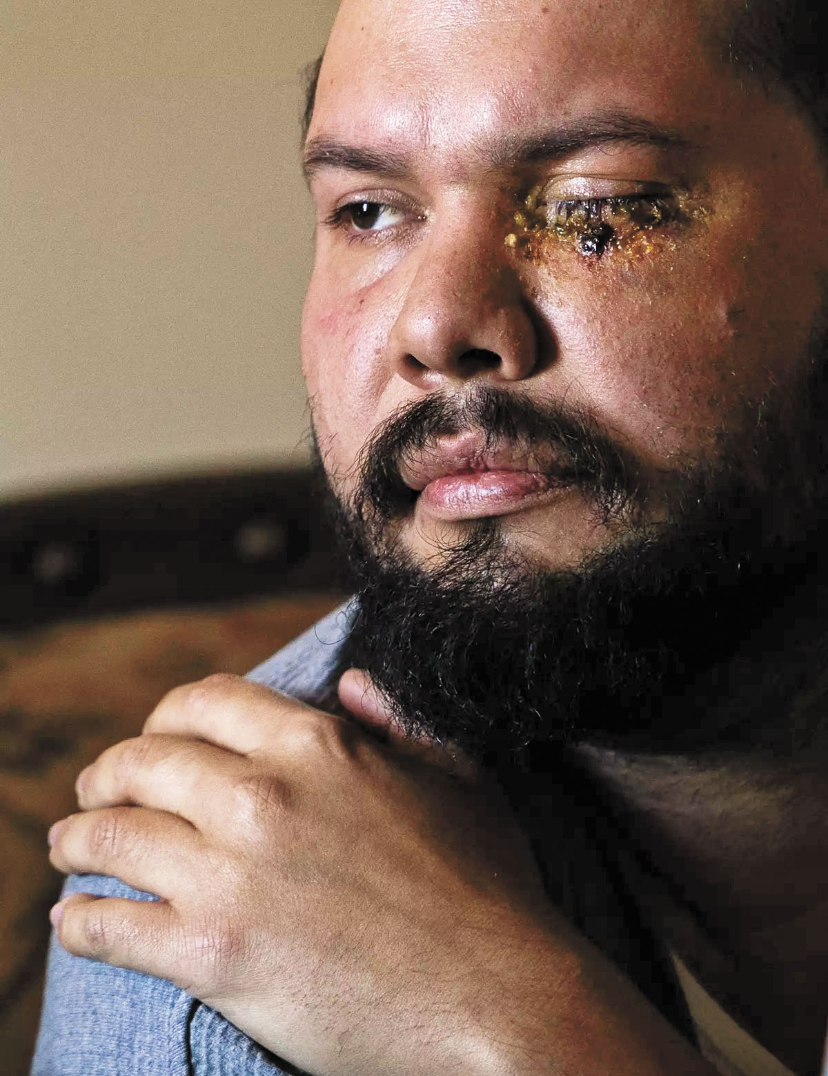 羅德里格斯眼睛被射傷，目前正在家中休養。洛杉磯時報