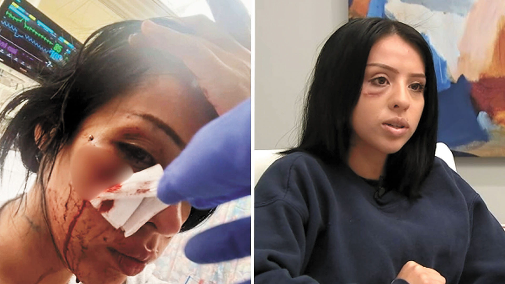 25歲的洛馬斯被一枚非致命性彈藥擊中臉部。ABC 7