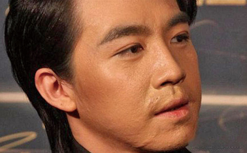 事故後，俞灝明的臉上有明顯疤痕。網上圖片