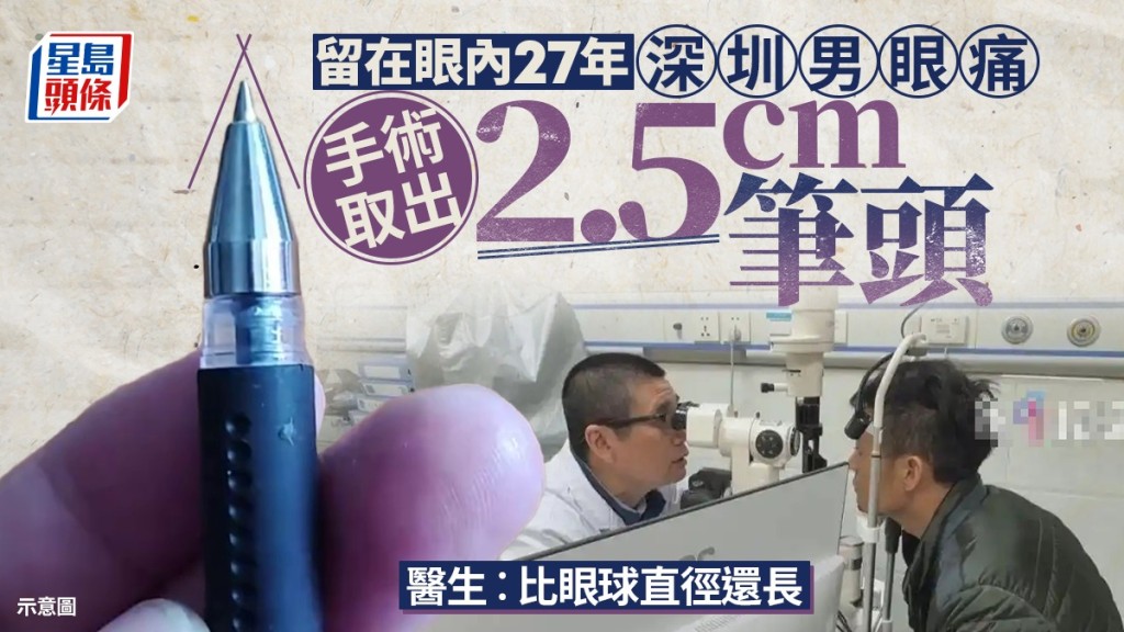 深圳男眼痛27年 手術驚見2.5厘米原子筆頭!竟是同學爭執時所留