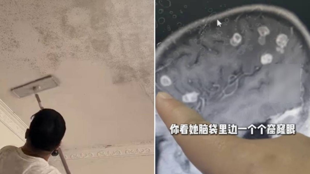 【恐怖個案】河南6歲女童大掃除後高燒17日 腦部竟被黴菌「啃出」逾20個坑洞！