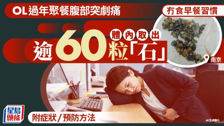 南京女子長期飲食不定時 膽囊手術取出逾60粒結石