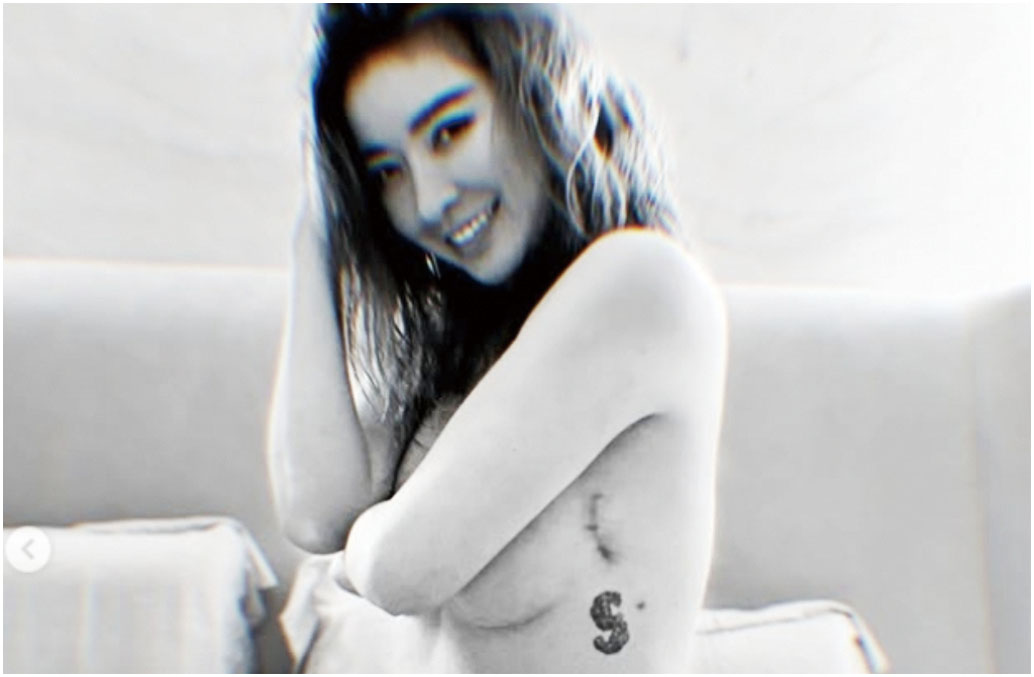 許維恩的手術痕跡清晰可見。網上圖片