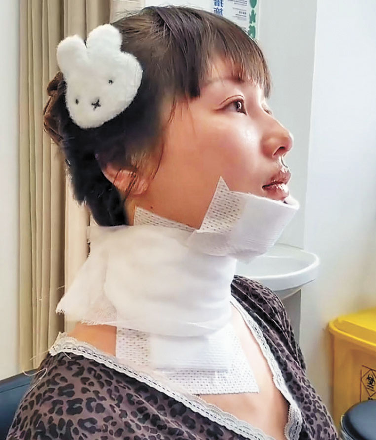 王添羽經診斷為二級燒傷。網上圖片