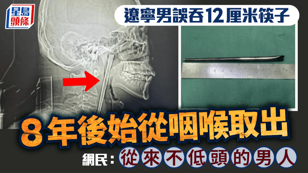 遼寧男子誤吞12厘米金屬筷子 八年後終經微創手術取出