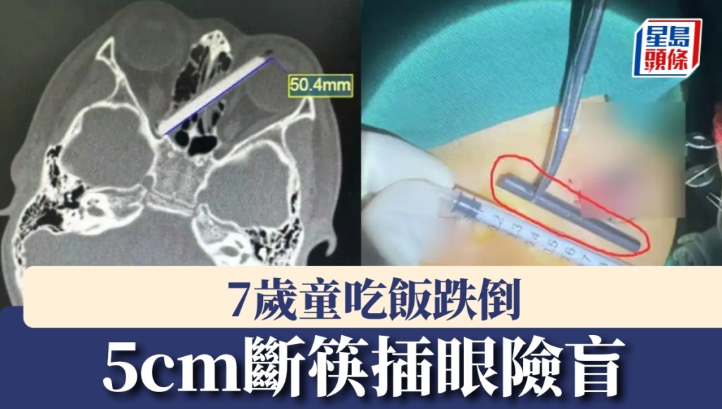 杭州7歲男童意外跌倒 斷筷插入眼眶險釀失明