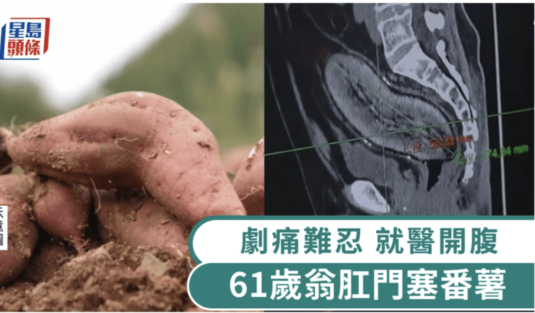 四川成都61歲翁肛門塞入巨型番薯，痛不欲生，連紅酒開瓶器都無法取出