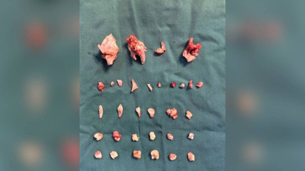 湖南少女運動腹痛 手術取出卵巢畸胎瘤含24顆牙齒