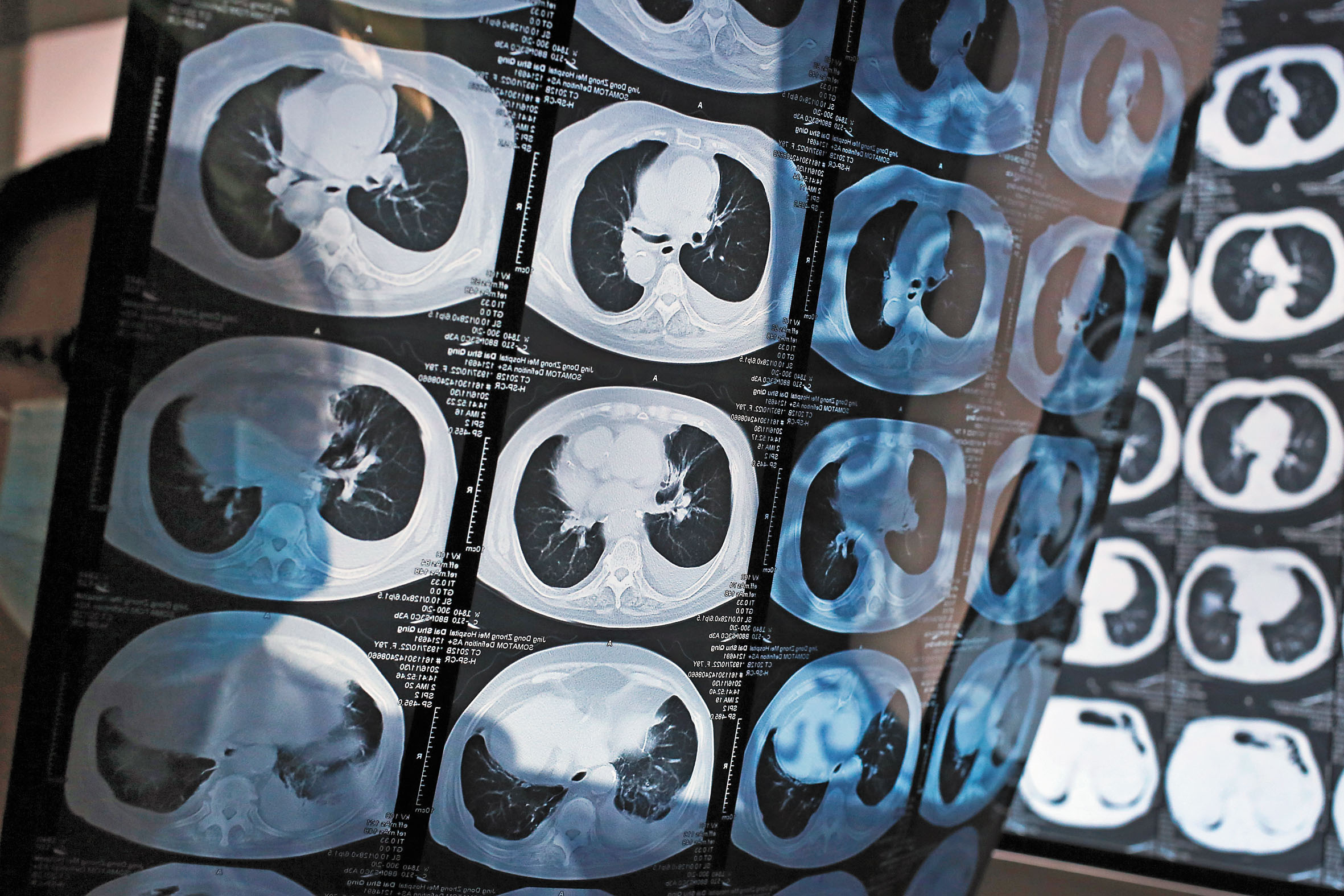 全球癌症死亡病例中最多是肺癌。美聯社資料圖片