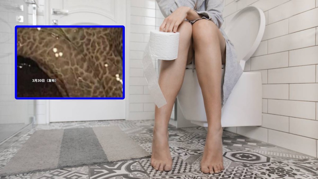 西安女子長期依賴通便產品致腸道病變 內窺鏡檢查發現結腸黑變病