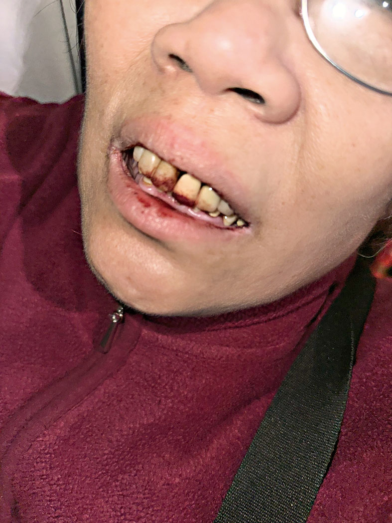 受傷華裔老婦29日晚嘴裡滿是鮮血。      莊文怡辦公室提供