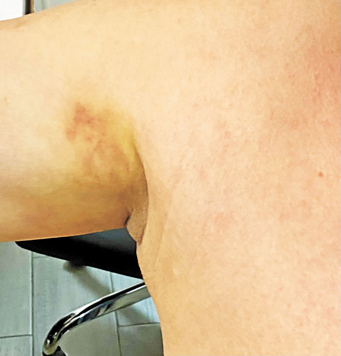 何先生因被捕1日腋窩仍淤青。   張之銘攝