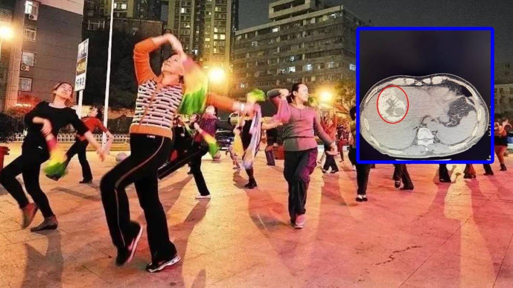 湖南七旬婦跳廣場舞過度 致肝腫瘤破裂緊急送醫