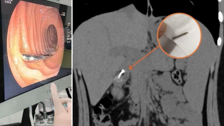 初中生課堂分神誤吞圓規針頭 醫生緊急手術成功取出