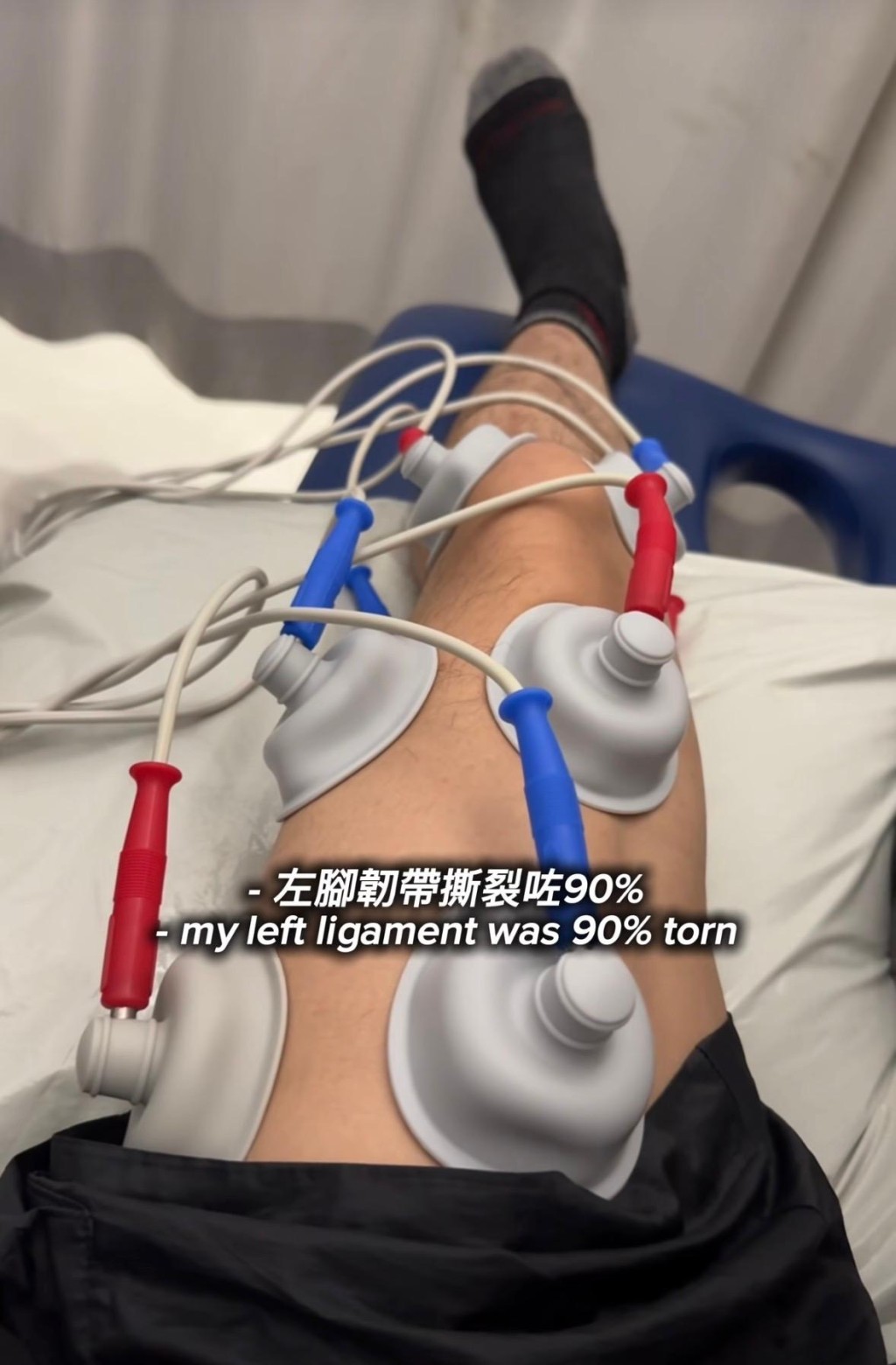 ANSONBEAN曾因拍攝劇集《存酒人》導致左腳韌帶嚴重撕裂，一度對前路感到迷茫。