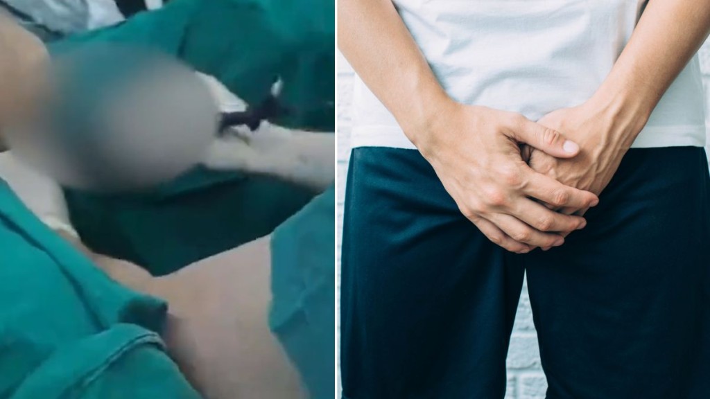 深圳男子自行注射硅膠增大下體 致嚴重感染需手術取出