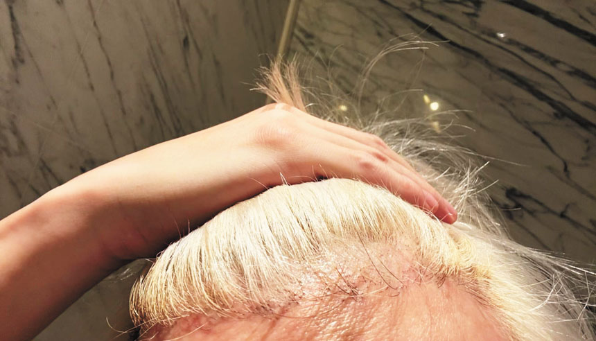 薛之謙頭上長滿水泡。網上圖片