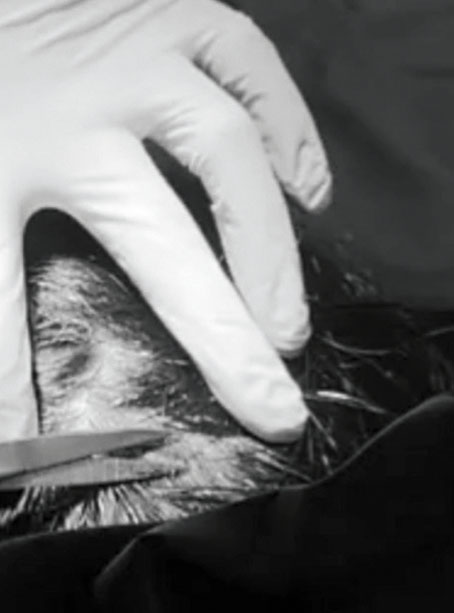 ■丫頭曬出醫生修剪傷口周邊頭髮的畫面。網上圖片