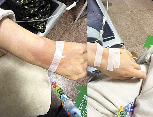 王曉晨輸液時血管被針頭穿破，手背腫脹。網上圖片