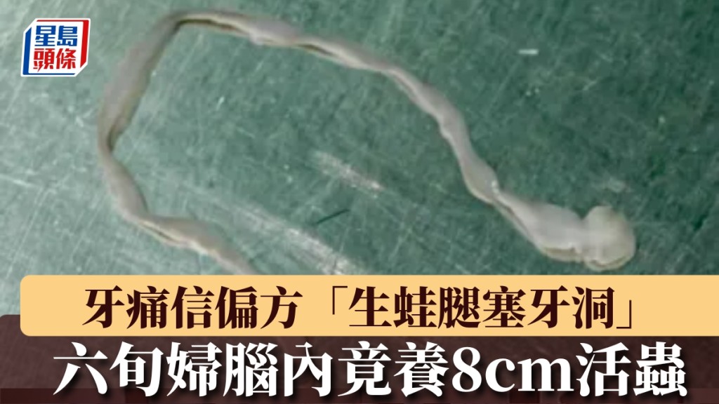 牙痛誤信偏方 生蛙腿塞牙洞致腦內寄生蟲感染