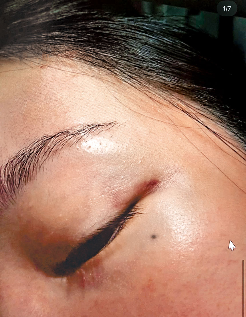 ■前妻公開傷勢及驗傷報告控訴金正勳家暴及逼拍不雅片。