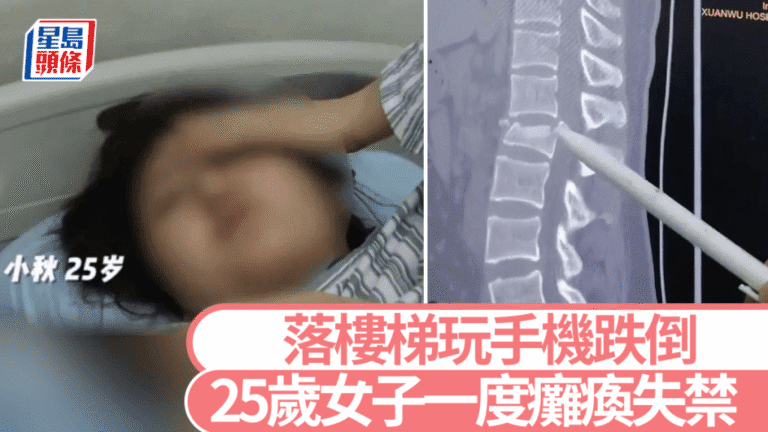 25歲女子下樓梯看手機跌倒 腰椎爆裂性骨折一度面臨癱瘓風險