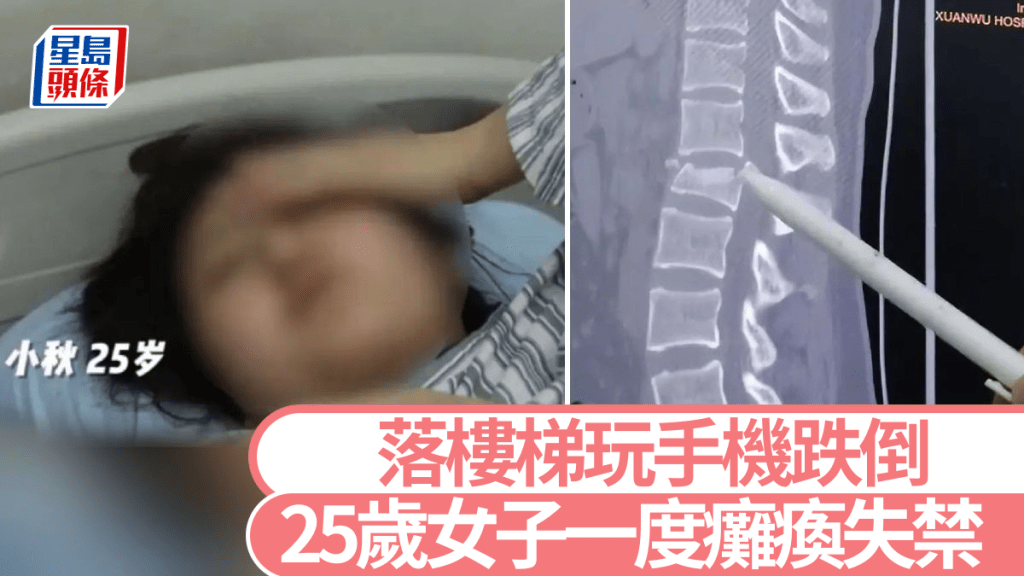 25歲女子下樓梯看手機跌倒 腰椎爆裂性骨折一度面臨癱瘓風險