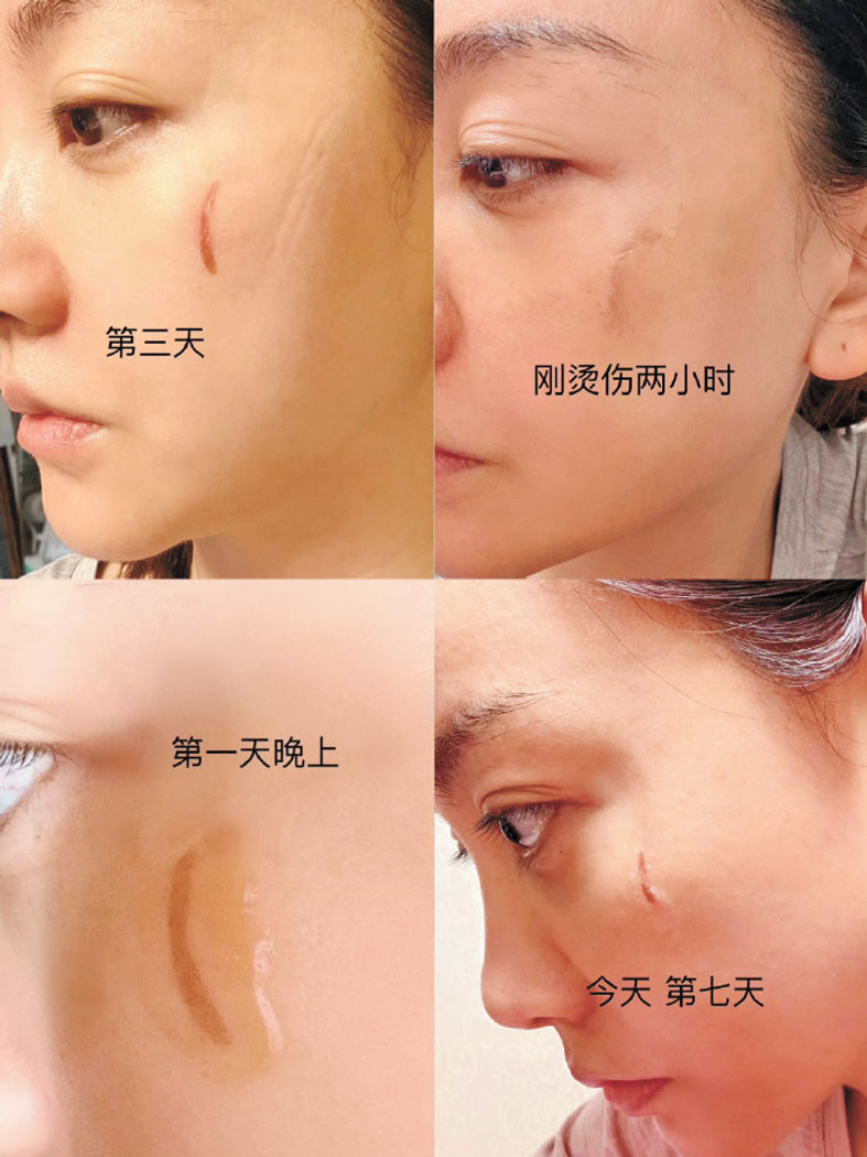 楊蓉曬出臉部被燙傷後的疤痕恢復照。網上圖片