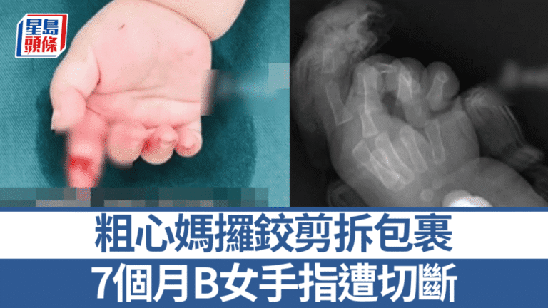 山東母親拆包裹時不慎剪斷7個月大女嬰手指 經手術成功接駁