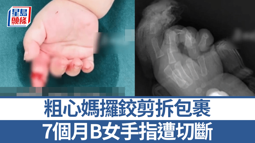 山東母親拆包裹時不慎剪斷7個月大女嬰手指 經手術成功接駁