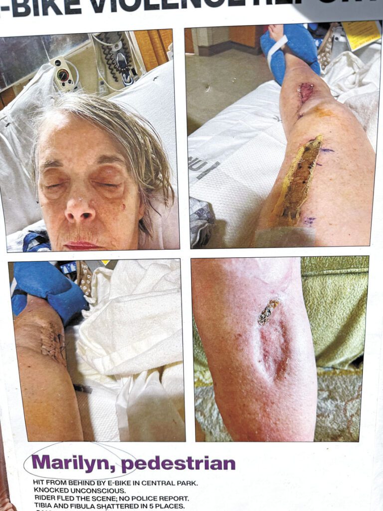 推動「陸瑞英法案」上，一名電動單車受害者展示自己被撞後在醫院的狀況。