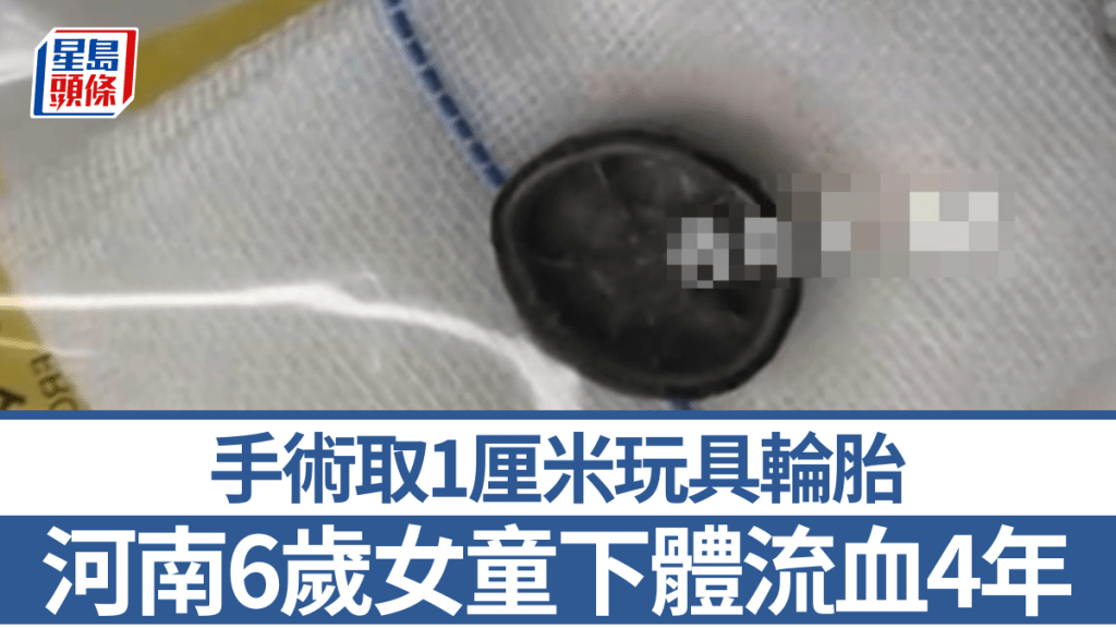 河南女童長期陰道出血 手術取出體內玩具輪胎