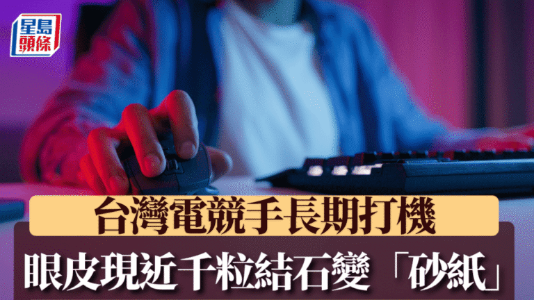 台灣電競選手雙眼近千顆眼結石 長期高強度用眼成罕見病例