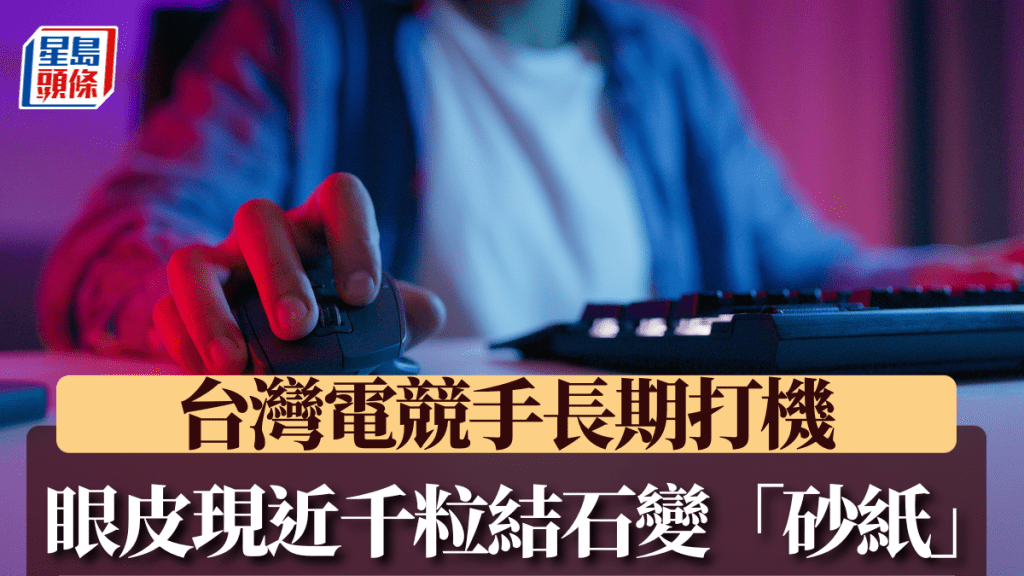 台灣電競選手雙眼近千顆眼結石 長期高強度用眼成罕見病例
