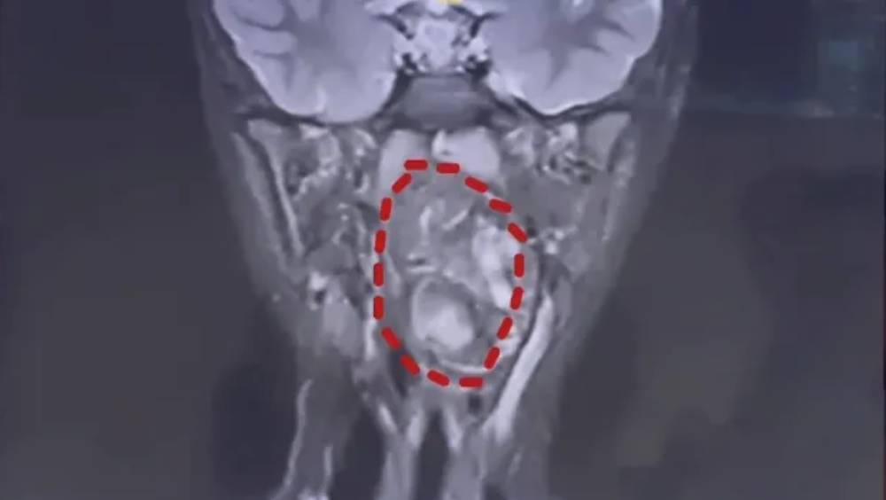 六歲男童嚴重鼻鼾 揭喉嚨藏罕見畸胎瘤