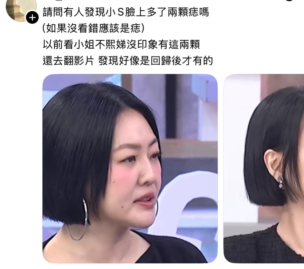 小S臉上的痣成為網民熱議話題。