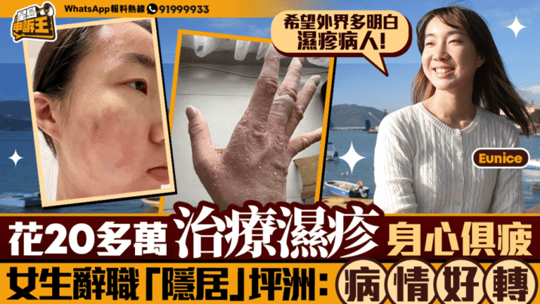 對抗濕疹之路：港女花費逾20萬治療 辭職遷居坪洲改善病情