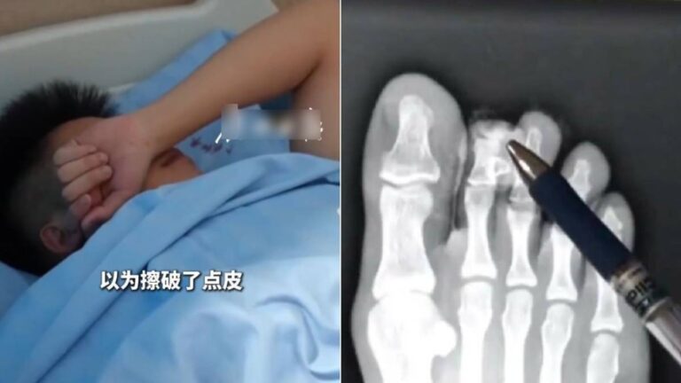 廣東少年穿人字拖邊行邊看手機 踢中石頭致腳趾斷裂