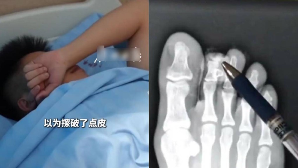 廣東少年穿人字拖邊行邊看手機 踢中石頭致腳趾斷裂