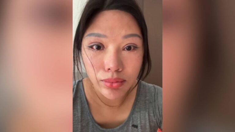 江蘇女子割雙眼皮致無法閉眼 獲賠後因家屬網上發聲遭判退還部分款項