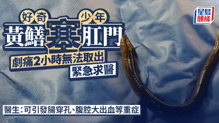 少年誤塞活黃鱔入肛門 醫生緊急手術取出