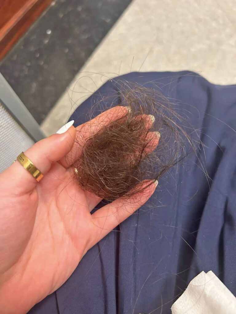 猶太女子上月在地鐵C車慘遭襲擊，被對方扯掉一大撮頭髮。CombatASemitism X圖片