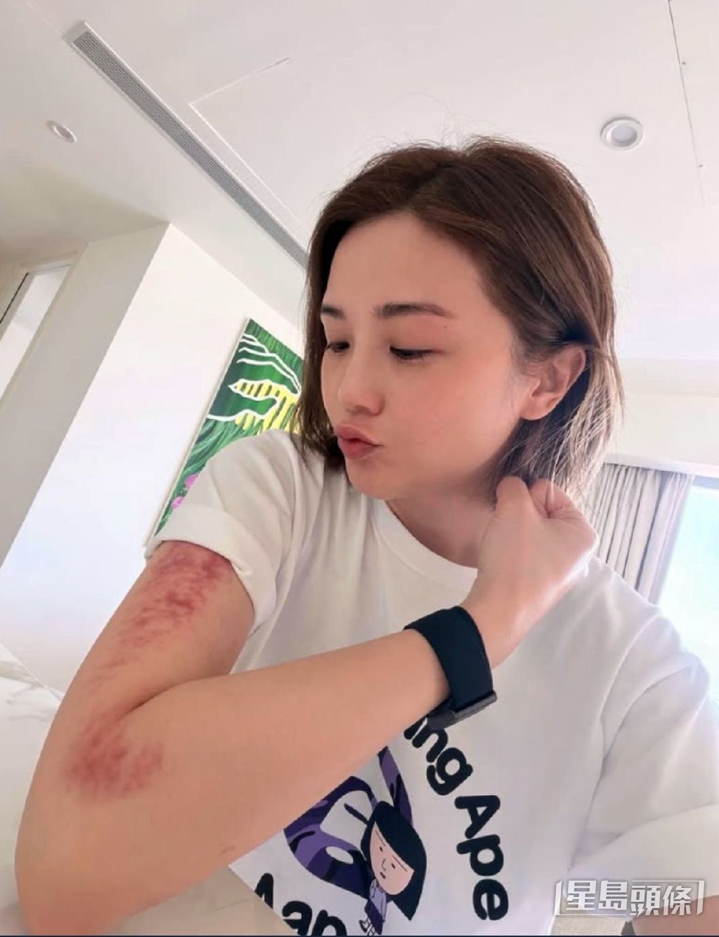 阿Sa在社交網展示手臂痧痕，好友鄭希怡留言戲稱是「家暴」。