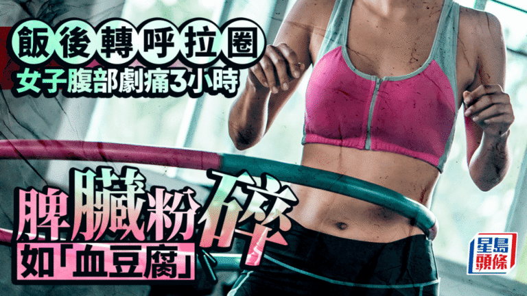 浙江女子飯後使用加重呼拉圈致脾臟破裂 醫生籲注意運動安全