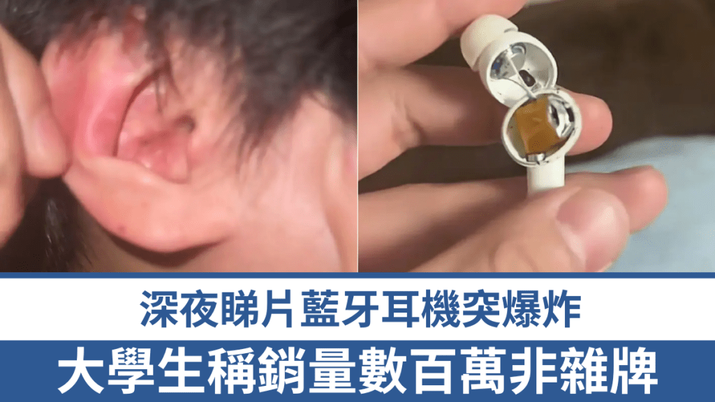 網購熱銷藍牙耳機突爆炸 鄭州大學生耳道內遇險