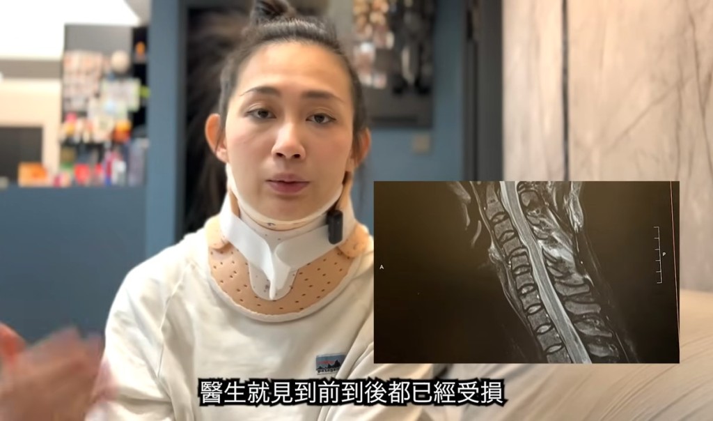 楊焉指醫生表示其兩截頸椎受損，強烈建議她進行手術。