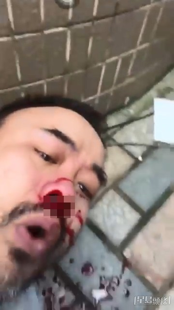 邵子風遇襲時，面部及鼻部受傷流血。