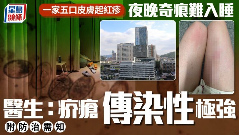 深圳一家五口同患疥瘡 醫生指傳染性強易與濕疹混淆