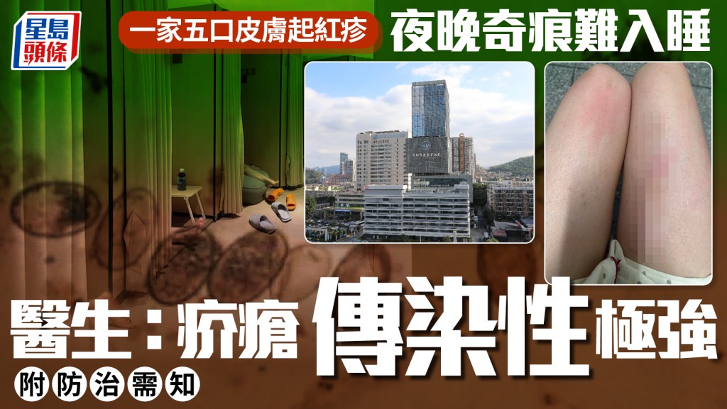 深圳一家五口同患疥瘡 醫生指傳染性強易與濕疹混淆